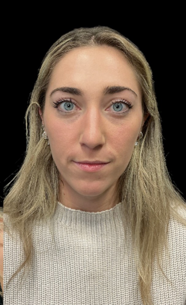 Wrinkle Relaxers after treatment at Juvly Aesthetics
