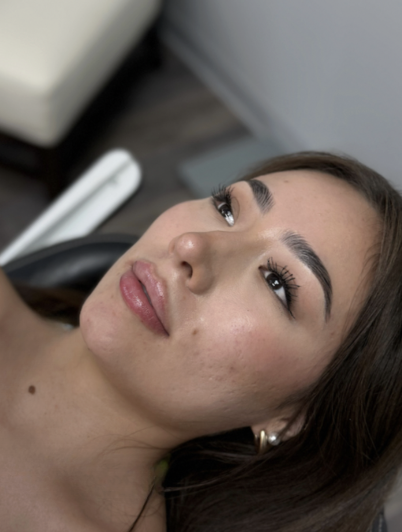 Lip Filler