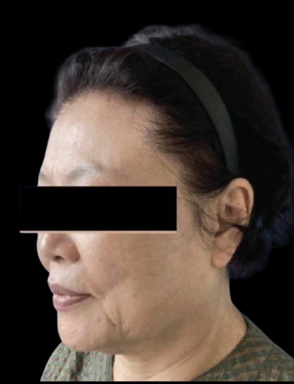 XTherma before treatment at Juvly Aesthetics