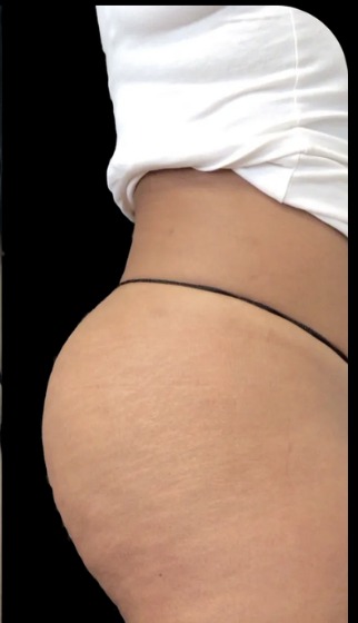 Non-Surgical BBL after treatment at Juvly Aesthetics