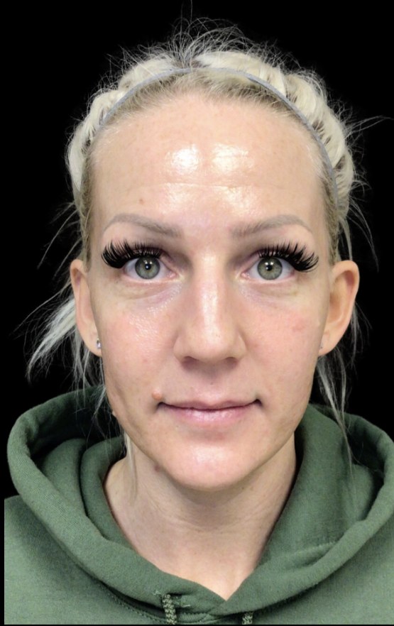JLyft Non-Surgical Facelift before treatment at Juvly Aesthetics