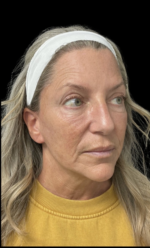 Sylfirm X before treatment at Juvly Aesthetics
