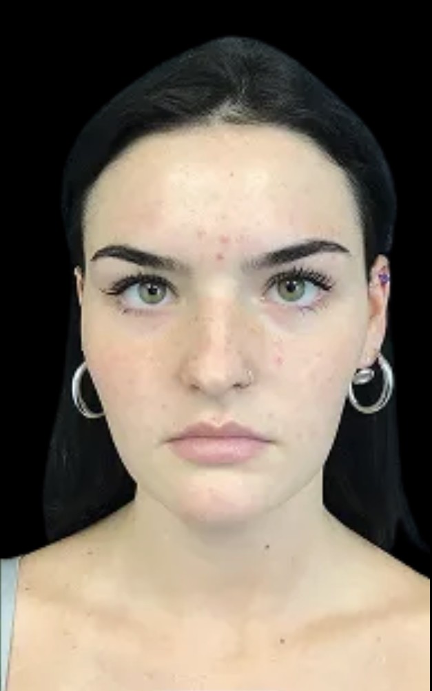 Masseter Slimming after treatment at Juvly Aesthetics