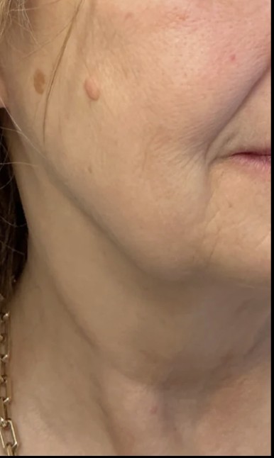 Treatment stacking after treatment at Juvly Aesthetics