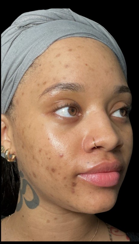 Chemical Peel before treatment at Juvly Aesthetics