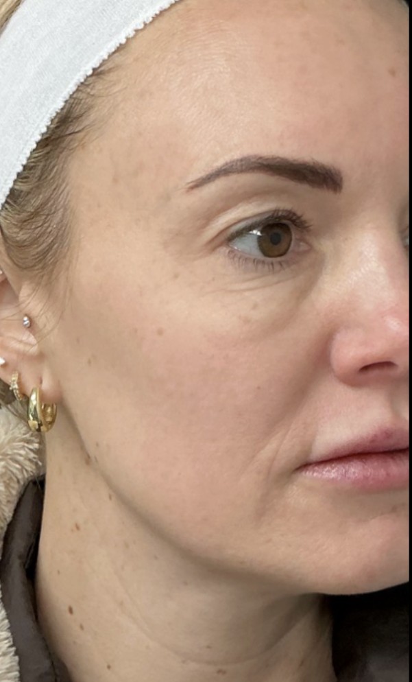 Laser after treatment at Juvly Aesthetics
