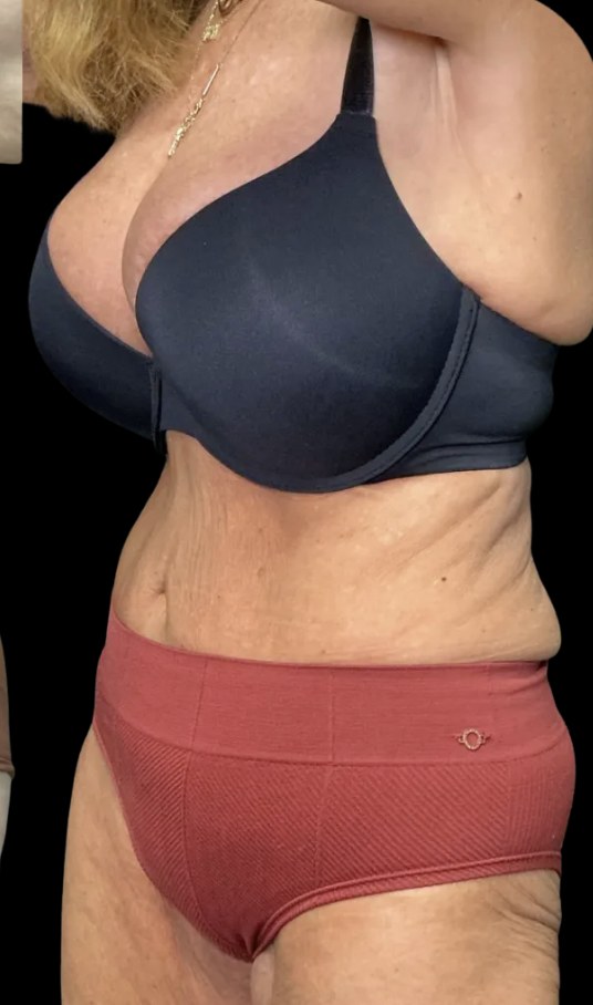 Wellness Rx Membership after treatment at Juvly Aesthetics
