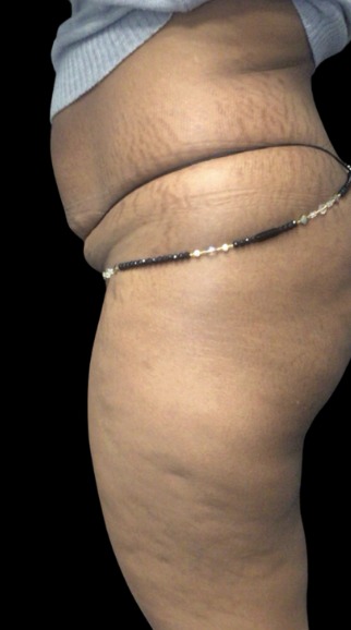 Non-Surgical BBL before treatment at Juvly Aesthetics