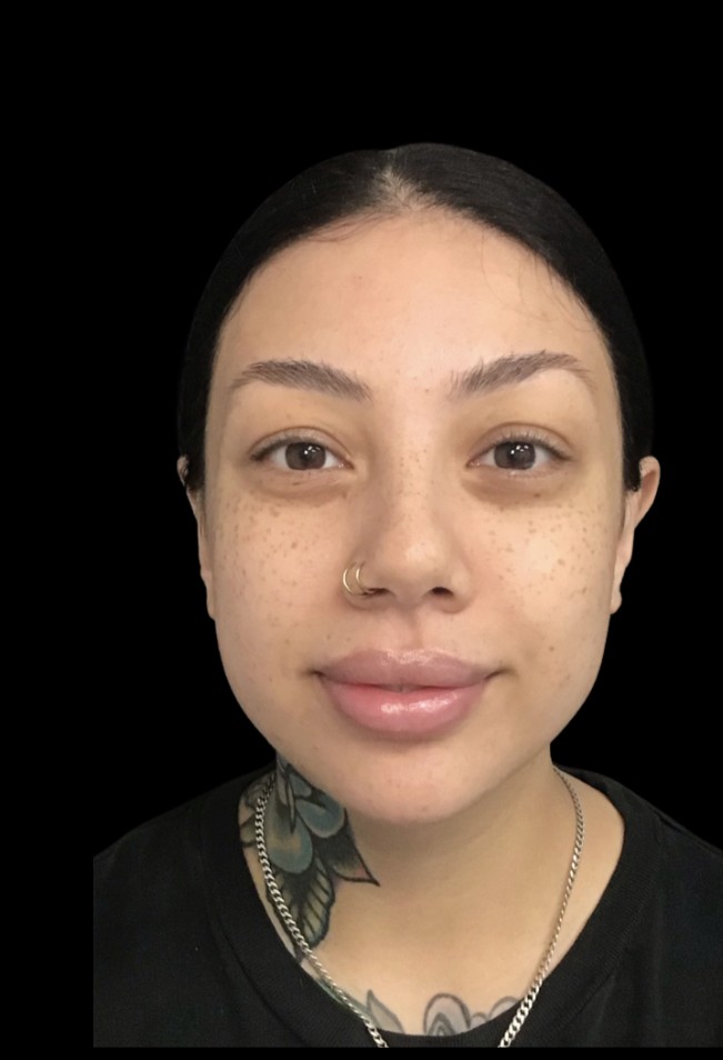Masseter slimming before treatment at Juvly Aesthetics