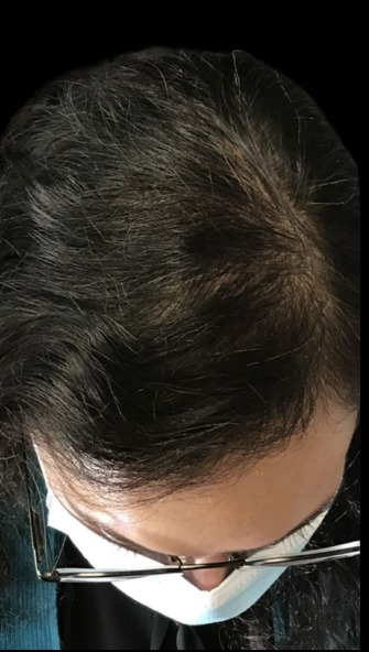 Hair Loss Treatments after treatment at Juvly Aesthetics