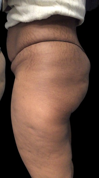 Non-Surgical BBL after treatment at Juvly Aesthetics