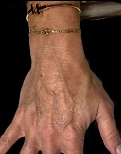 Hand filler before treatment at Juvly Aesthetics