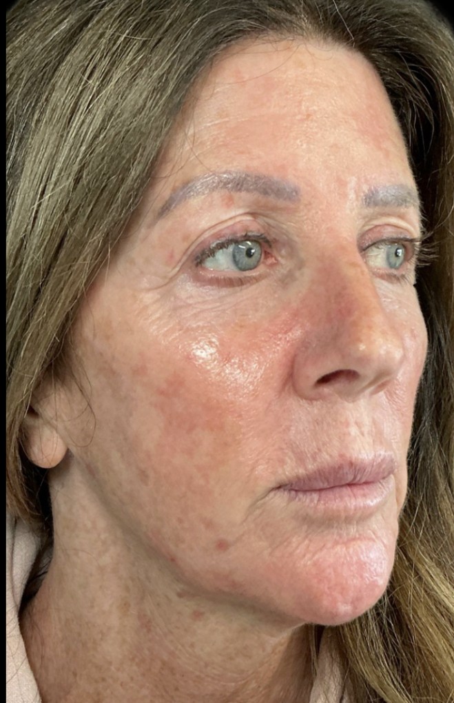 Laser before treatment at Juvly Aesthetics