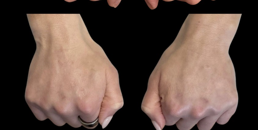Hand filler after treatment at Juvly Aesthetics