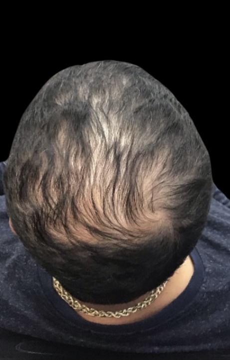 Hair Loss Treatments before treatment at Juvly Aesthetics