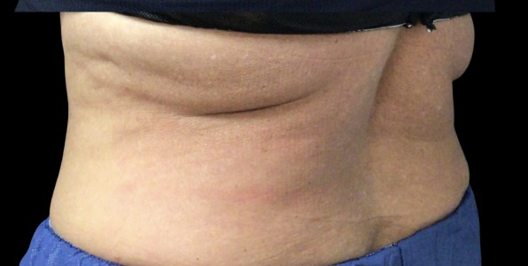 CoolSculpting after treatment at Juvly Aesthetics