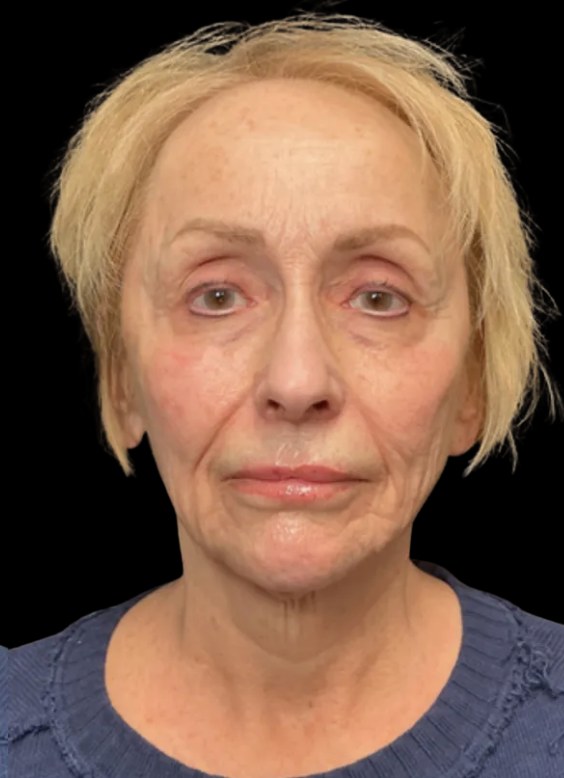 JLyft Non-Surgical Facelift after treatment at Juvly Aesthetics