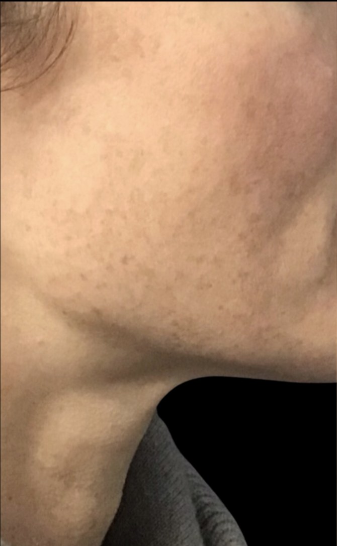 Standard Microneedling before treatment at Juvly Aesthetics
