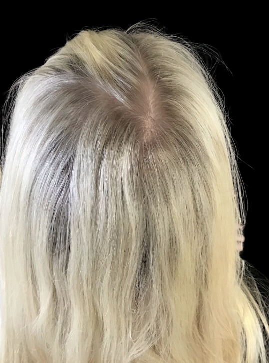 Hair Loss Treatments after treatment at Juvly Aesthetics