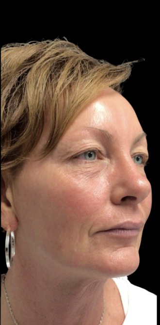 Standard Microneedling after treatment at Juvly Aesthetics