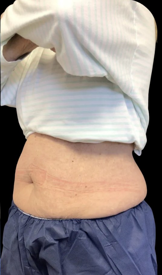 Wellness Rx Membership after treatment at Juvly Aesthetics
