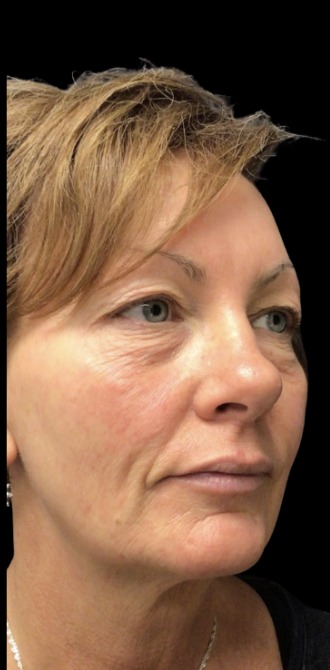 Standard Microneedling before treatment at Juvly Aesthetics