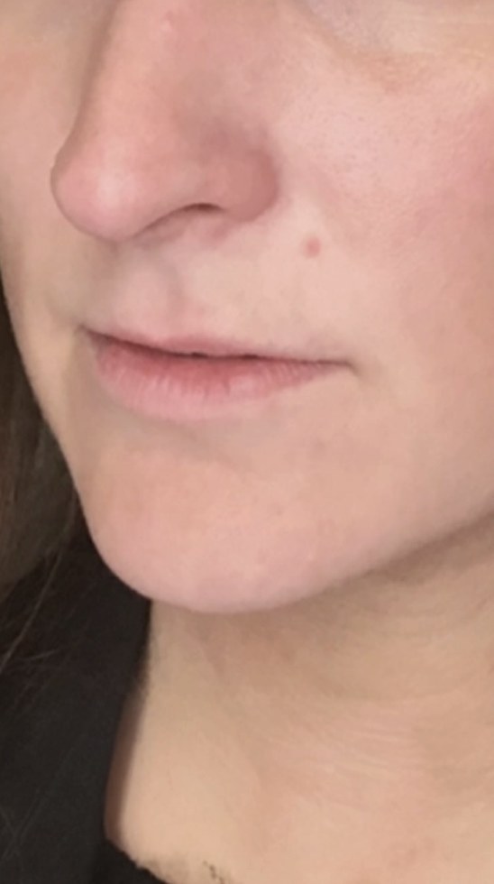Lip filler before treatment at Juvly Aesthetics