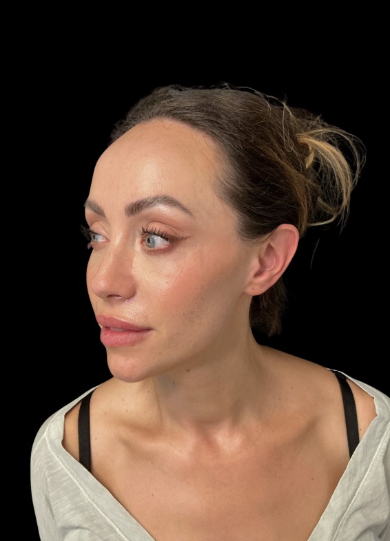 JLyft Non-Surgical Facelift after treatment at Juvly Aesthetics