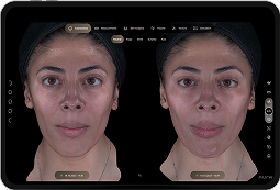 3D facial analysis before-and-after comparison view