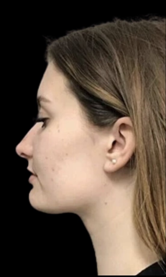 Kybella after treatment at Juvly Aesthetics