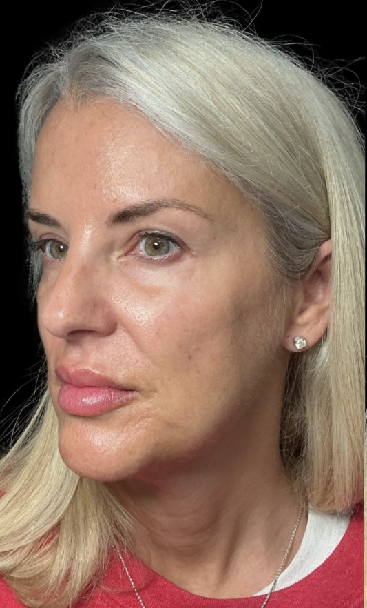 JLyft Non-Surgical Facelift before treatment at Juvly Aesthetics