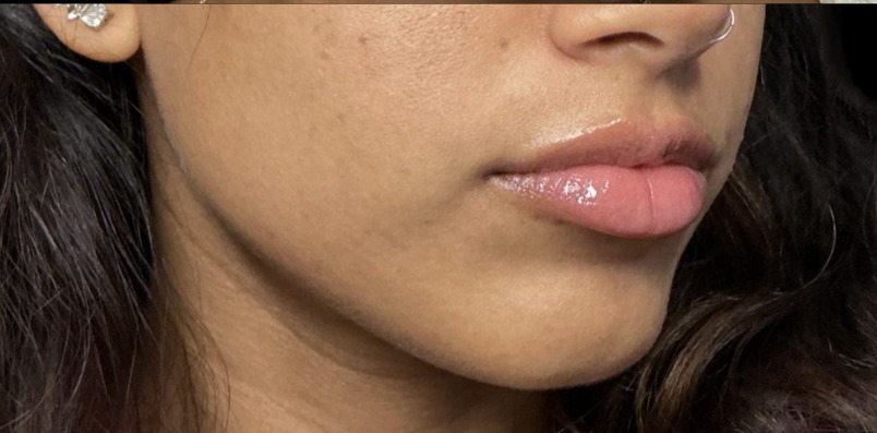 Standard Microneedling after treatment at Juvly Aesthetics
