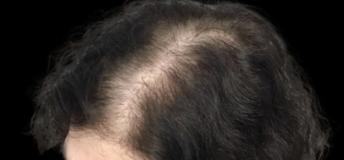 Hair Loss Treatments before treatment at Juvly Aesthetics