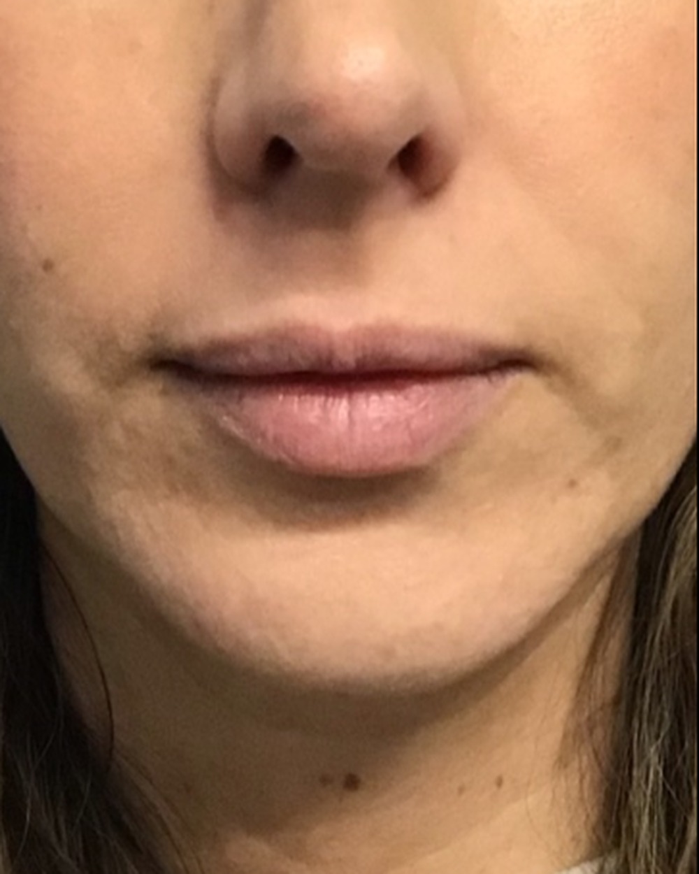 Lip filler before treatment at Juvly Aesthetics