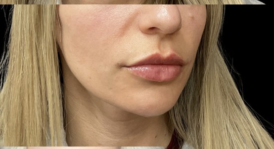 Lip filler after treatment at Juvly Aesthetics