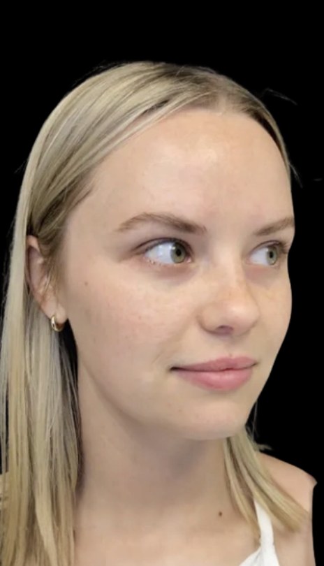 Lip filler before treatment at Juvly Aesthetics