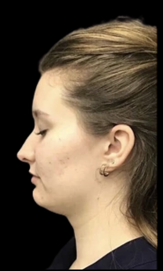 Kybella before treatment at Juvly Aesthetics