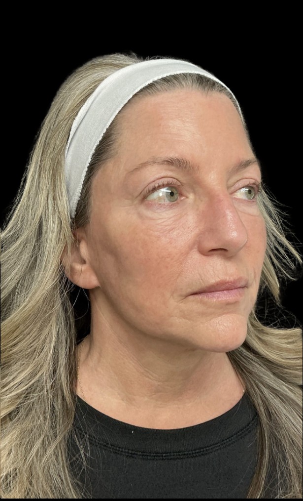 Sylfirm X after treatment at Juvly Aesthetics