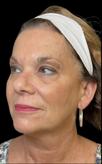 XTherma after treatment at Juvly Aesthetics