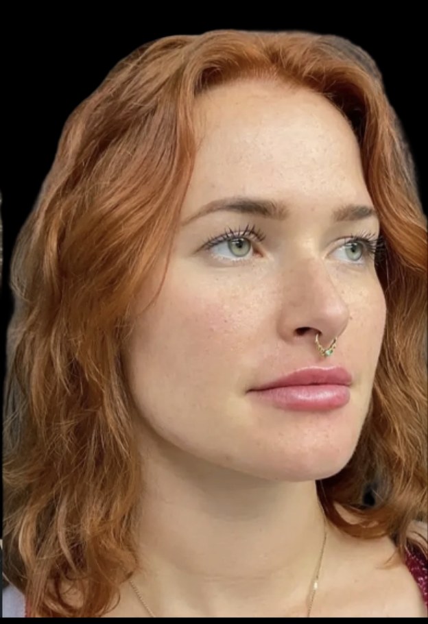 Lip filler after treatment at Juvly Aesthetics