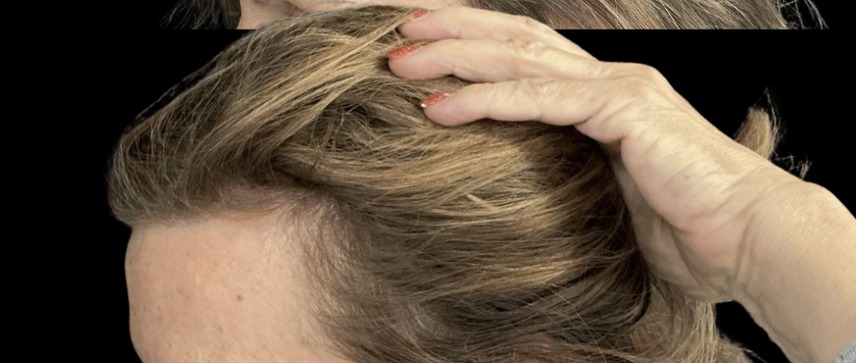 Hair Loss Treatments after treatment at Juvly Aesthetics