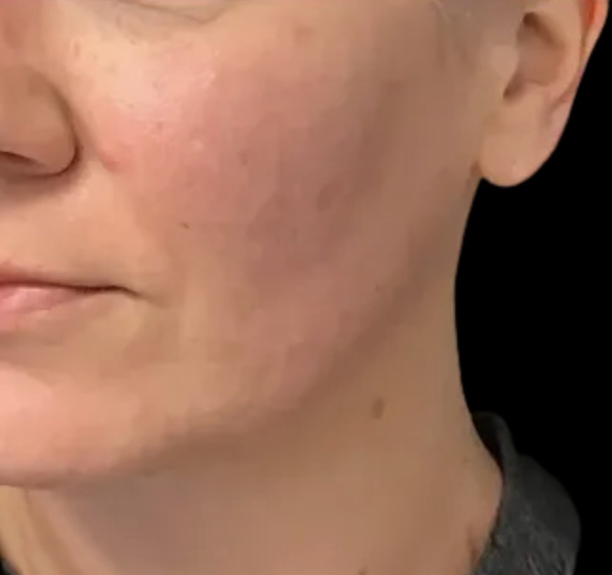 Standard Microneedling after treatment at Juvly Aesthetics