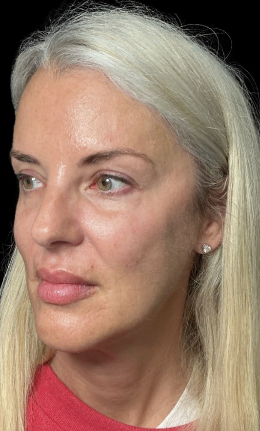 JLyft Non-Surgical Facelift after treatment at Juvly Aesthetics