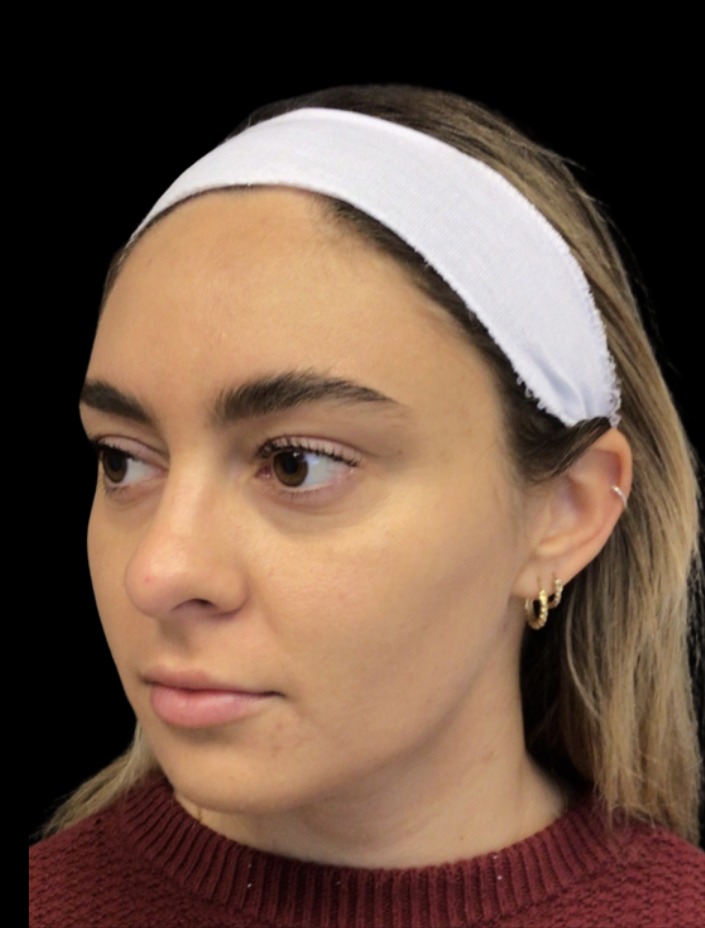 Cheek Filler before treatment at Juvly Aesthetics