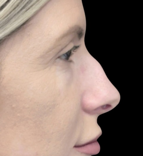 Liquid Nose Job before treatment at Juvly Aesthetics