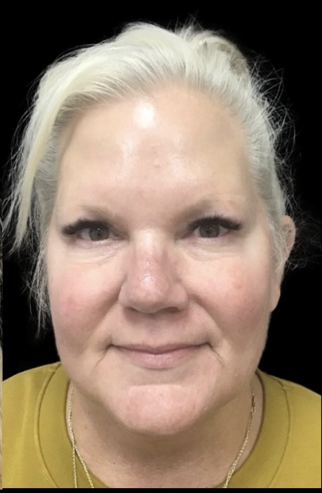 Laser after treatment at Juvly Aesthetics