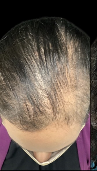 Hair Loss Treatments before treatment at Juvly Aesthetics