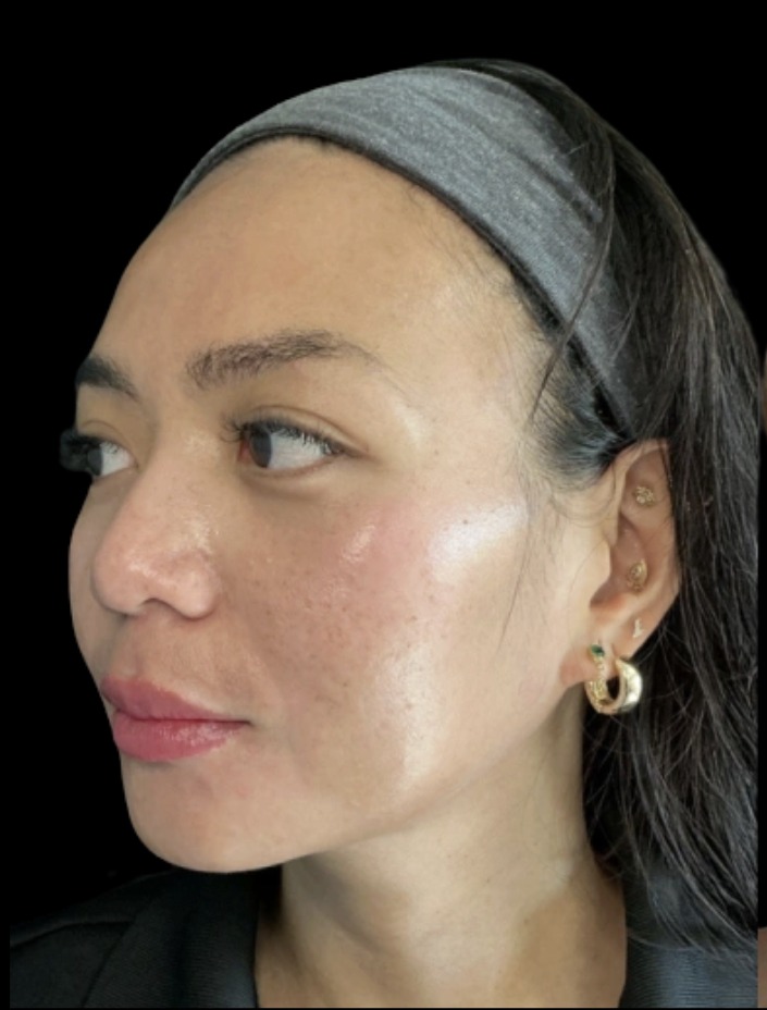 Cheek Filler before treatment at Juvly Aesthetics