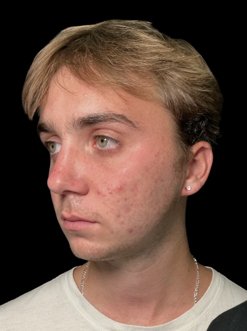 Standard Microneedling before treatment at Juvly Aesthetics