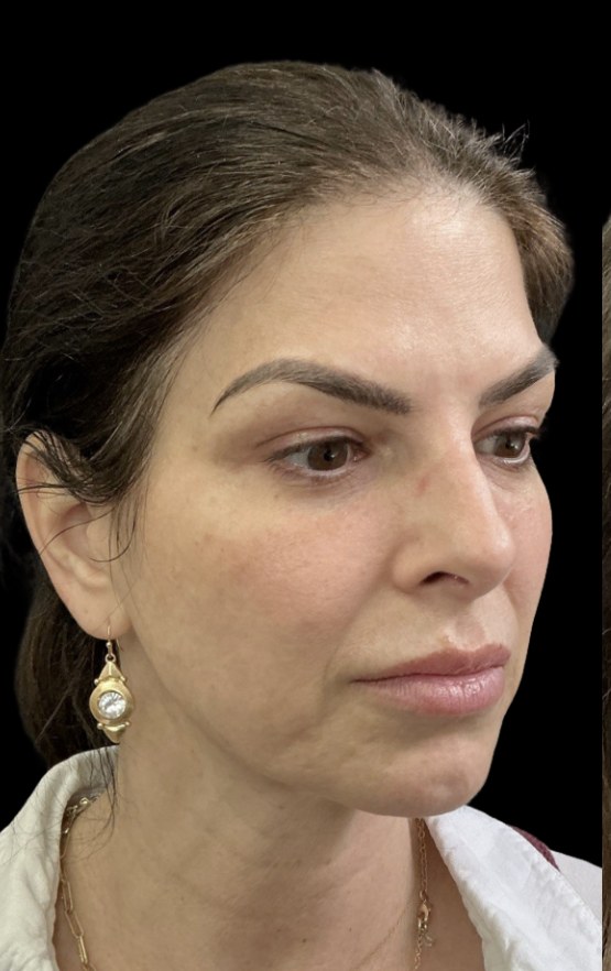 JLyft Non-Surgical Facelift before treatment at Juvly Aesthetics